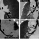 Image for article titled These 3D-Printed Devices Can Repair Damaged Airways in Kids' Lungs